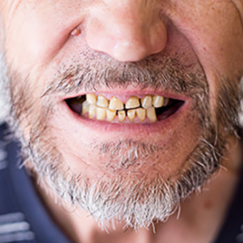 dental abrasion