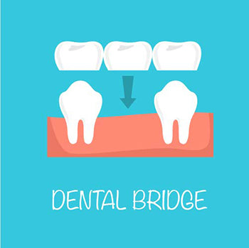 dental bridge
